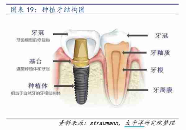种一颗牙上万将成历史？史上最难种植牙集采搅动千亿市场，牙茅何去何从